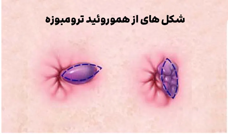 هموروئید ترومبوزه