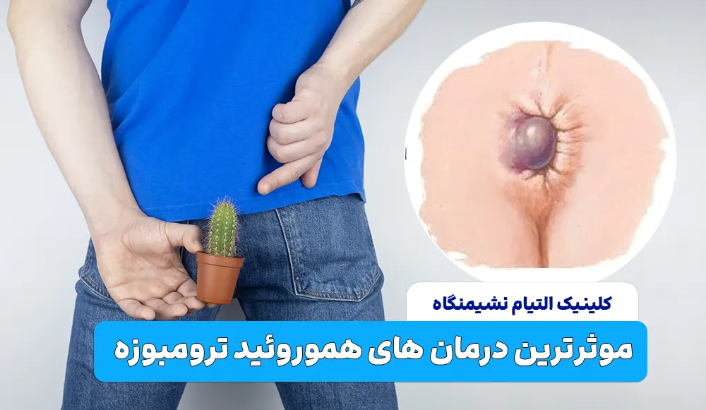 موثرترین درمان های هموروئید ترومبوزه