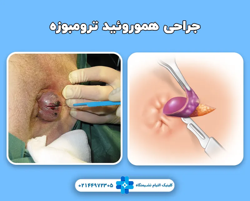 جراحی هموروئید ترومبوزه