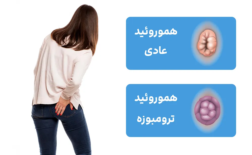 هموروئید عادی و ترومبوزه