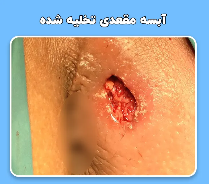 آبسه مقعدی تخلیه شده