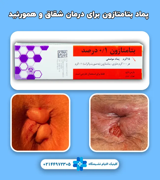 پماد بتامتازون برای درمان شقاق و همورئید