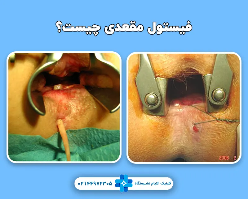 فیستول مقعدی