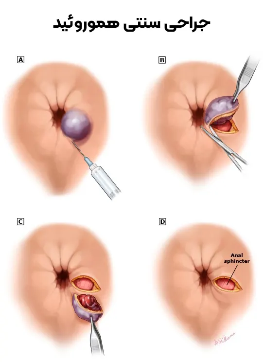 جراحی سنتی هموروئید