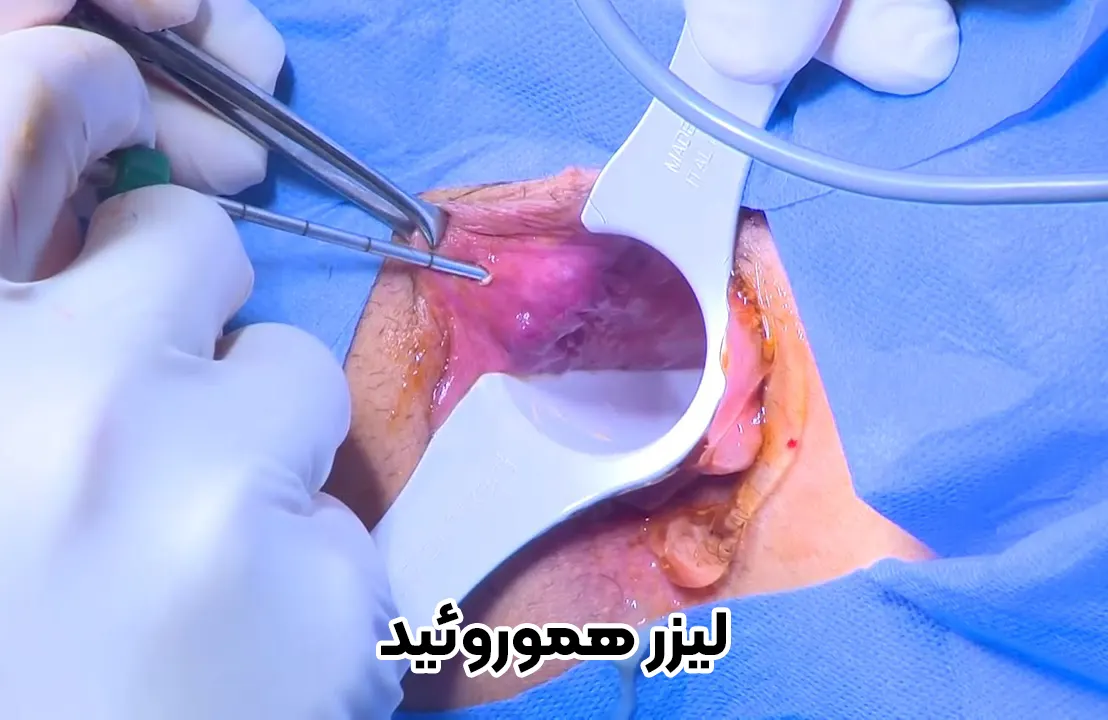 لیزر هموروئید