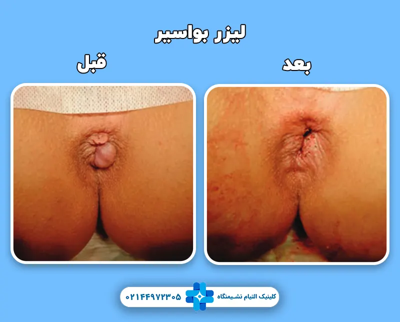 قبل و بعد لیزر هموروئید