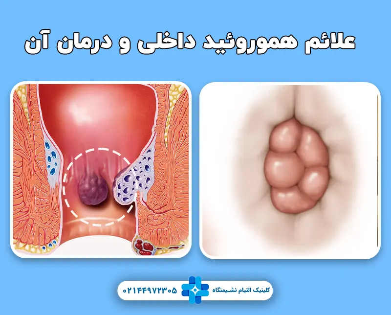 هموروئید داخلی و علائم آن و روش درمان