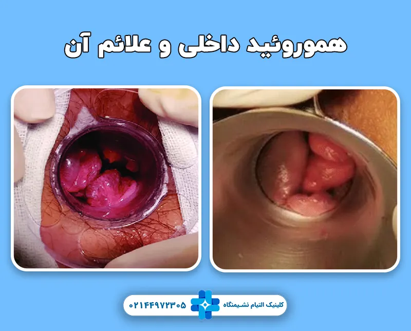 عکس هموروئید داخلی