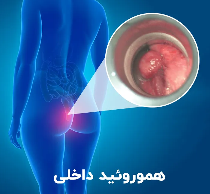 هموروئید داخلی