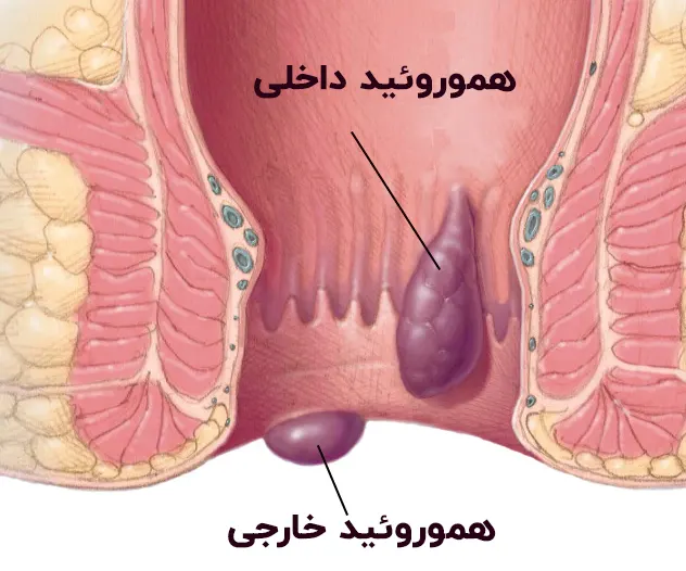هموروئید داخلی