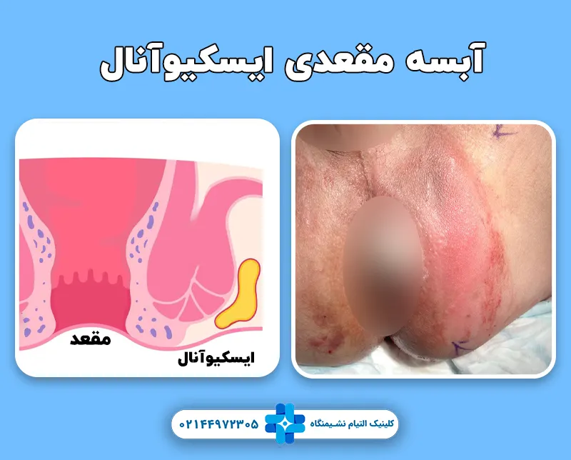 آبسه مقعدی ایسکیوآنال