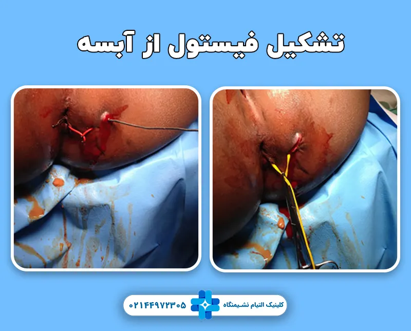 تبدیل آبسه به فیستول مقعد