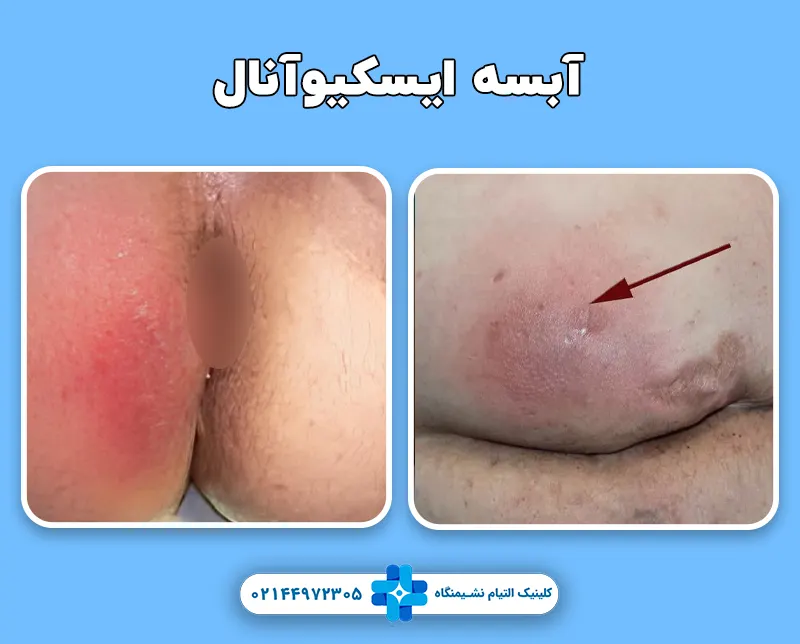 آبسه مقعدی ایسکیوآنال