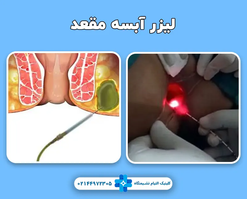 لیزر آبسه مقعد