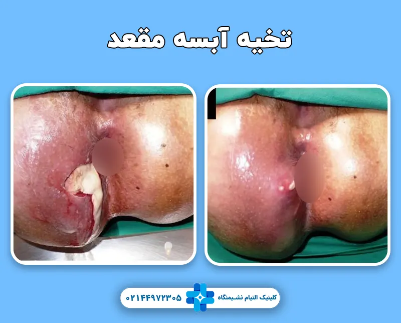 تخلیه آبسه مقعد