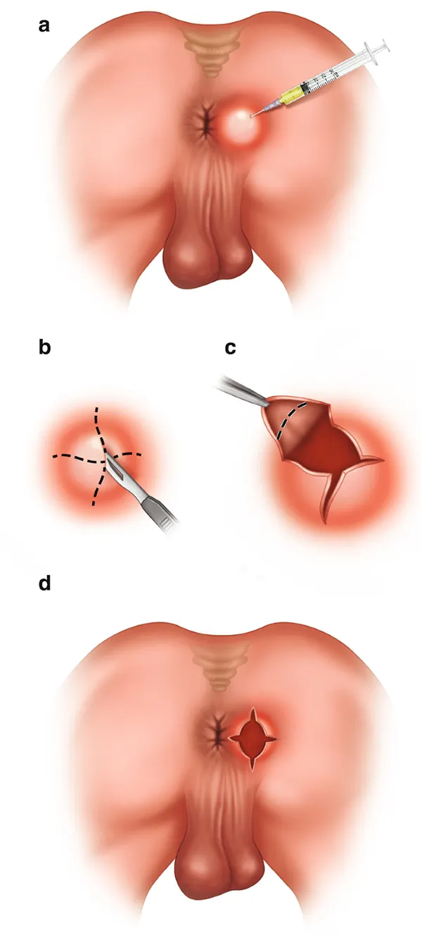 جراحی آبسه مقعد