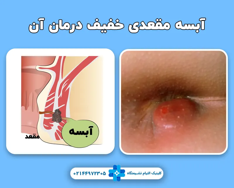 آبسه مقعدی خفیف