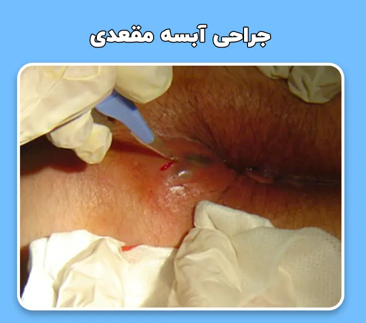 جراحی آبسه مقعدی خفیف
