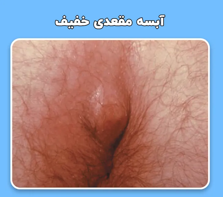 آبسه مقعدی خفیف