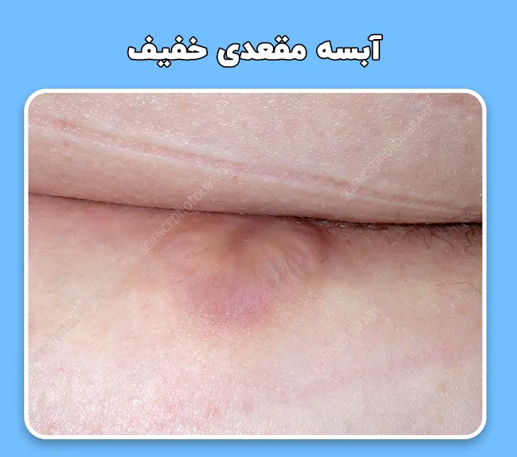 آبسه مقعدی خفیف