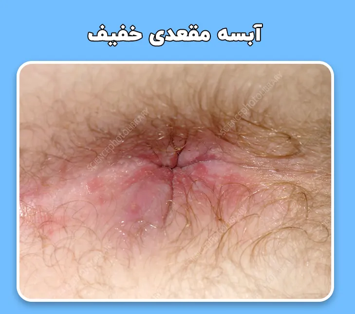 آبسه مقعدی خفیف