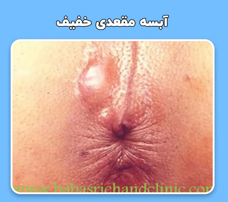 آبسه مقعدی خفیف