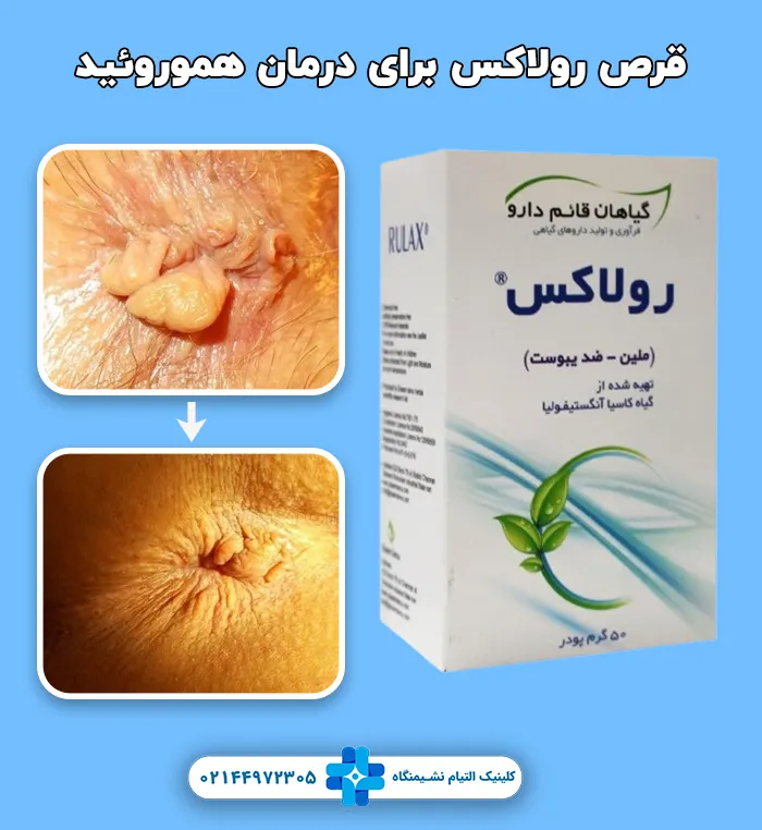 قرص رولاکس برای درمان هموروئید
