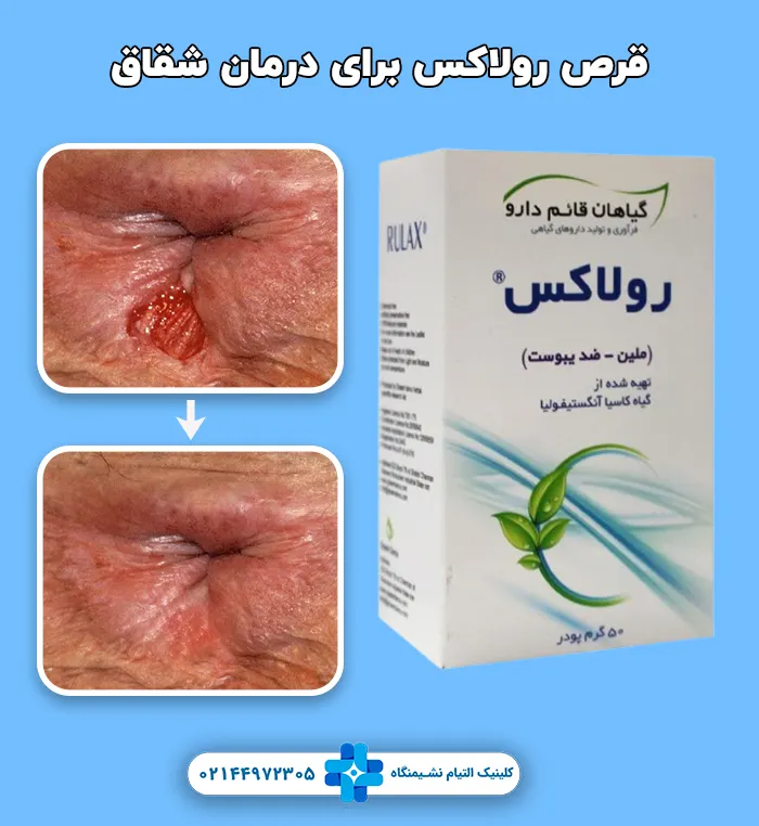 قرص رولاکس برای درمان شقاق