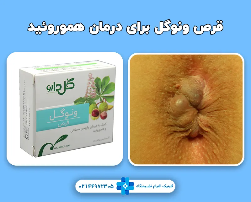 قرص ونوگل برای درمان بواسیر