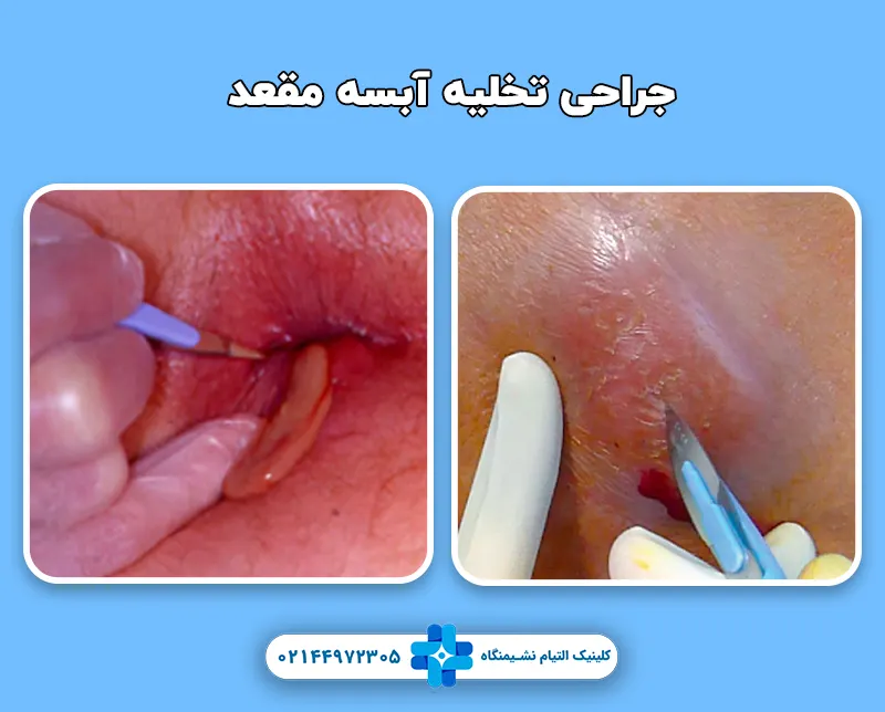 جراحی آبسه مقعد
