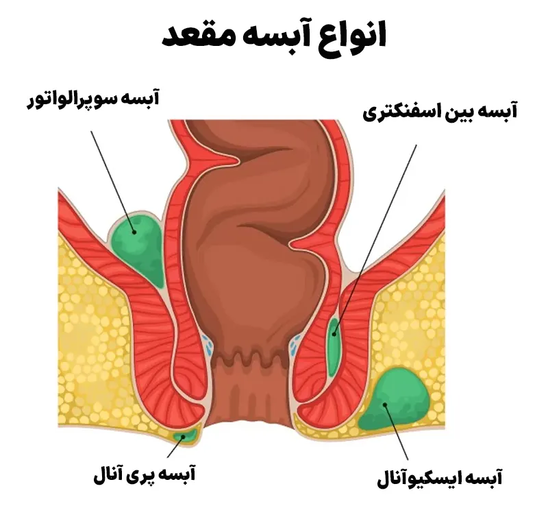 انواع آبسه مقعدی