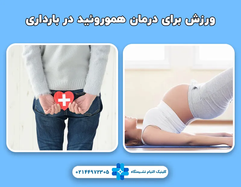ورزش برای درمان هموروئید در بارداری