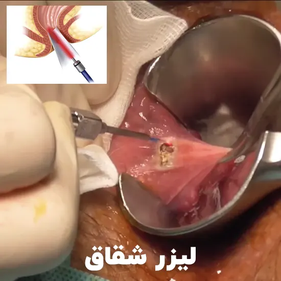 لیزر co2 شقاق