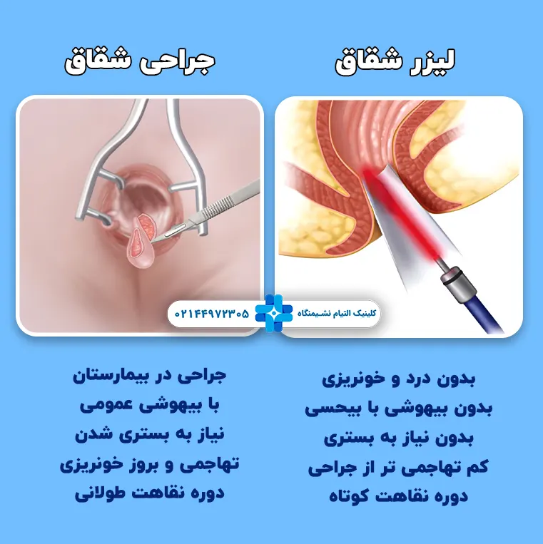 مقایسه لیزر شقاق با جراحی سنتی