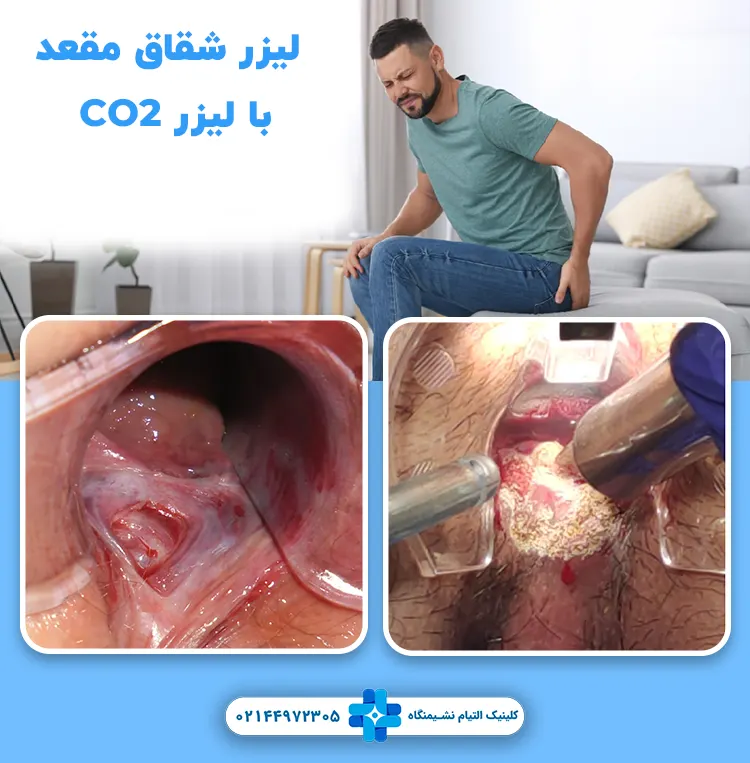 درمان شقاق با لیزر