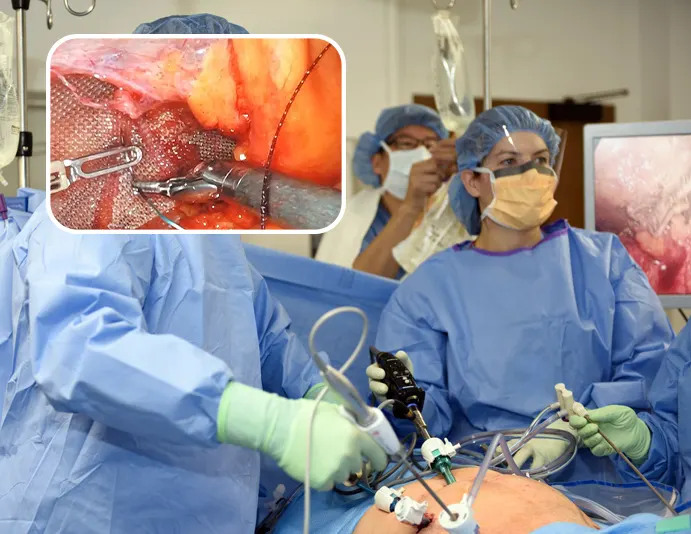 لاپاراسکوپی