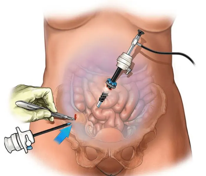 عمل لاپاراسکوپی روده
