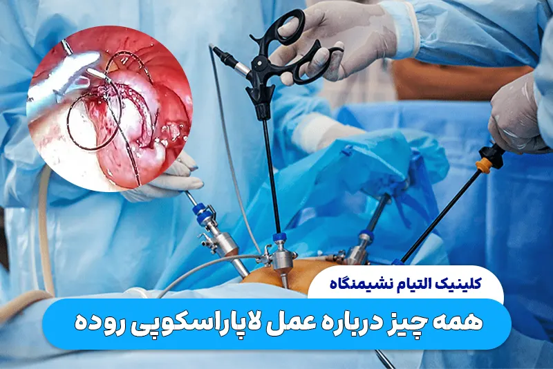 عمل لاپاراسکوپی روده