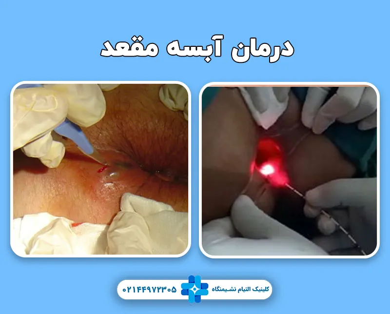 درمان آبسه مقعد