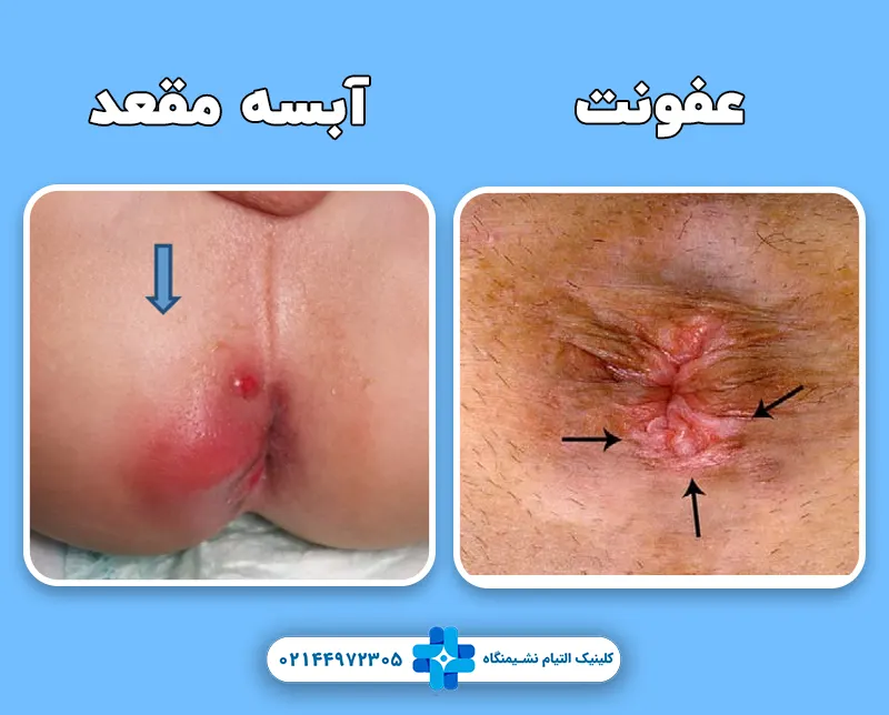 تفاوت علائم عفونت مقعد با آبسه مقعد