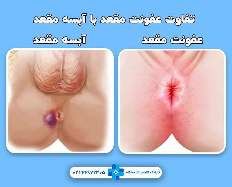تفاوت عفونت مقعد با آبسه مقعد