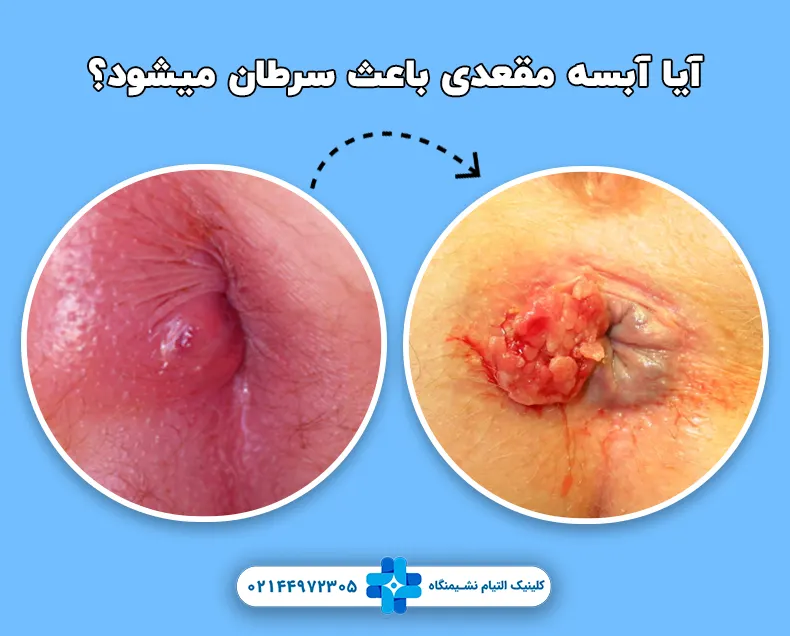 آیا آبسه مقعدی باعث سرطان میشود؟