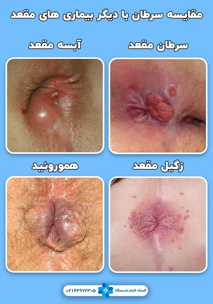 آبسه مقعد و سرطان