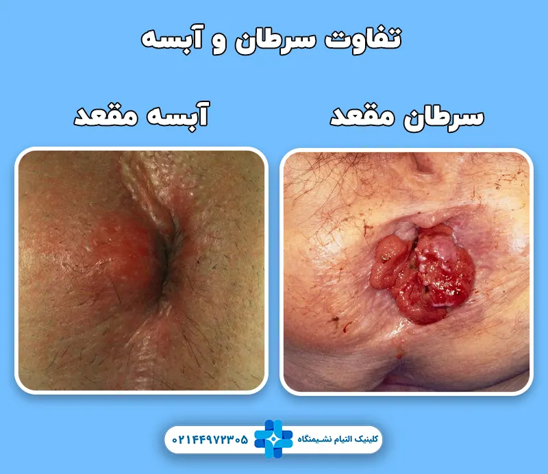 تفاوت آبسه مقعد با سرطان مقعد