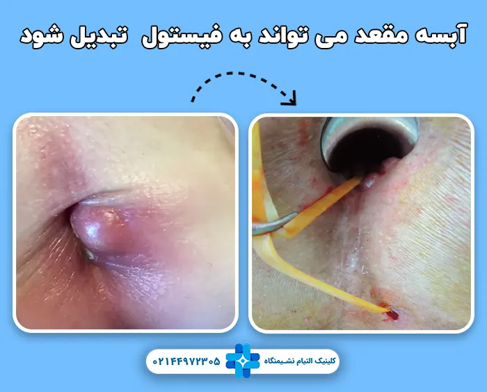 آبسه مقعدی و فیستول