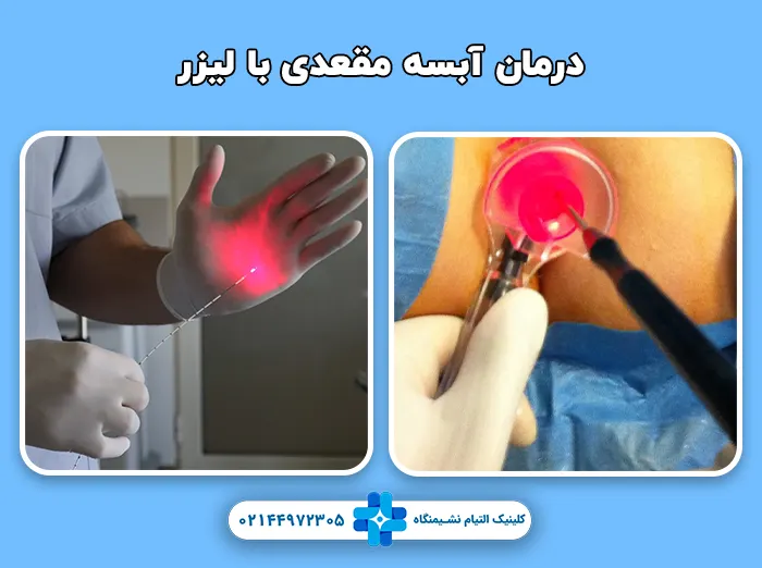 درمان آبسه مقعد