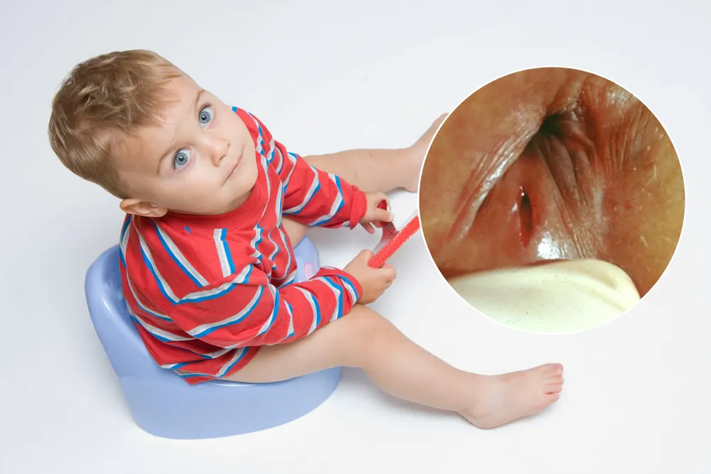 شقاق مقعدی در کودکان