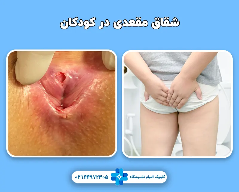 شقاق مقعدی در کودکان