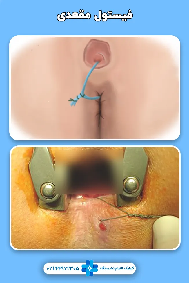 فیستول مقعد