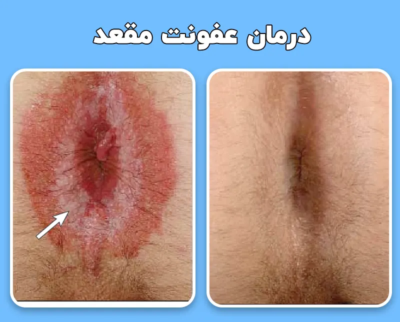 درمان عفونت مقعد